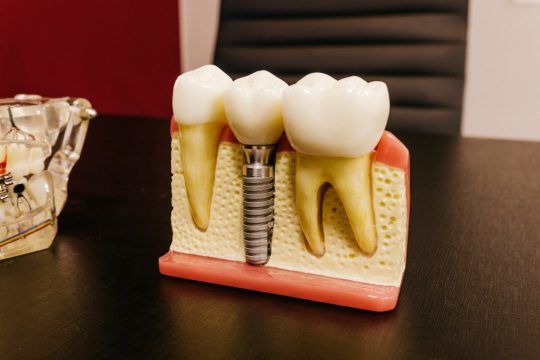 Dental-Implants-101_1.jpeg